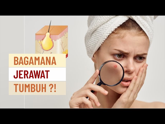 Bagaimana Jerawat Muncul di Kulit Wajah ?!