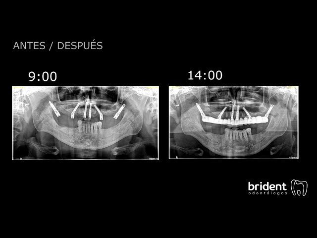 Sonríe sin esperar: Implantes de carga inmediata, tu nueva sonrisa en un solo día.