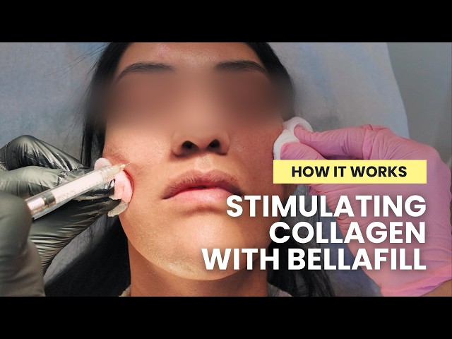 Dr Qazi : Restoring Volume and Stimulating Collagen with Bellafill