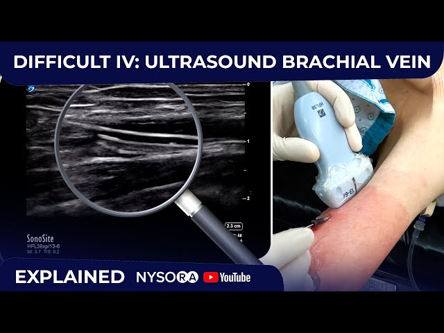 DIFFICULT IV: ULTRASOUND GUIDED BRACHIAL VEIN