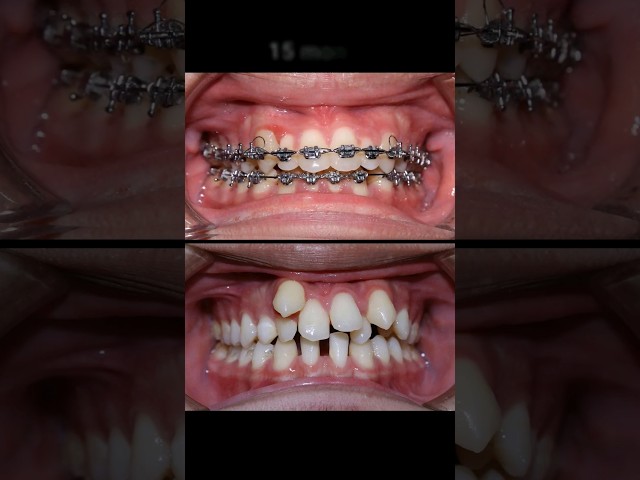 Braces very crooked #braces #orthodontist