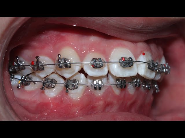 Quá trình niềng răng 2 năm (How braces work for 2 years)