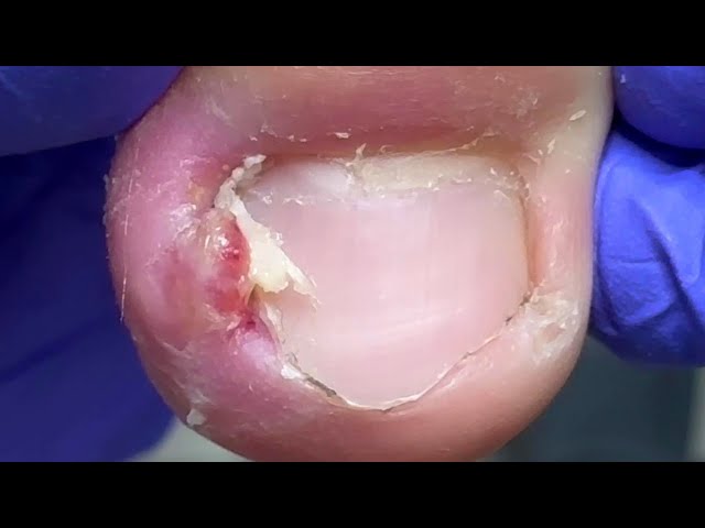 Hooks hidden under pustules, slowly digging out ingrown toenails【Doctor Liu Pedicure】