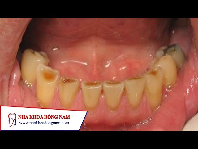 ✯ CẬN CẢNH ✯  - Quy trình trám răng bị mòn mặt nhai | NHA KHOA ĐÔNG NAM®