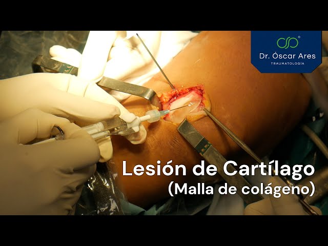 Lesión de Cartílago (Con fragmentos sueltos) - Dr. Oscar Ares