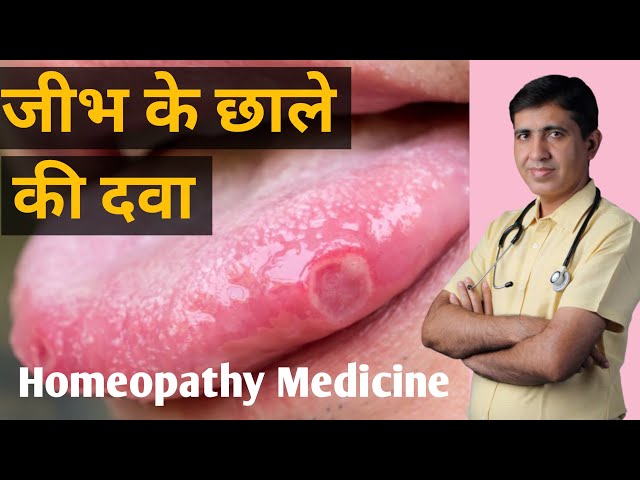 जीभ के छाले की दवा | Tongue Ulcer Treatment in Hindi | Jeebh Ke Chale ka Ilaj |Tongue Ulcer Medicine