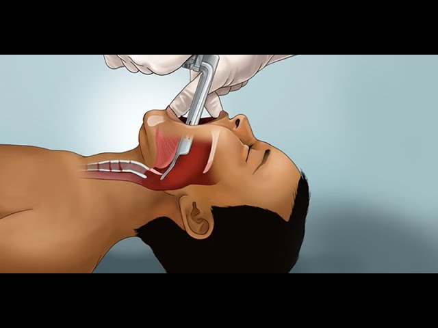 Pediatric Endotracheal Intubation by J. Nagler, et al. | OPENPediatrics