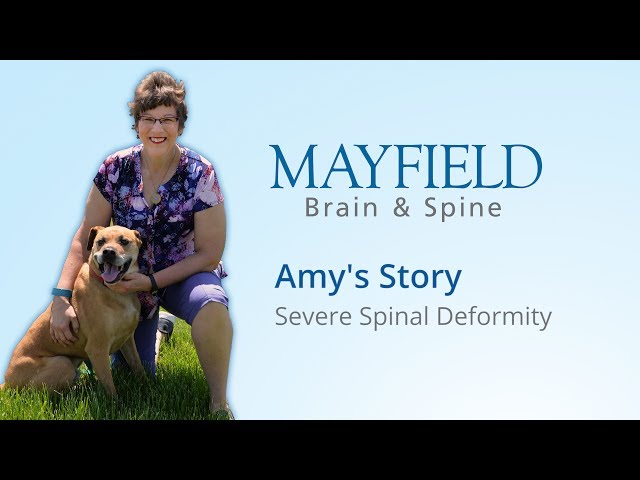 Amy's Story: Severe Spinal Deformity