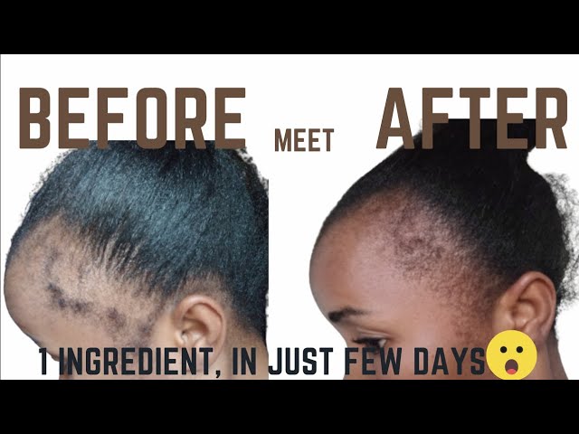 GROW YOUR EDGES IN JUST FEW DAYS USING 1 NATURAL INGREDIENT #hairgrowth #edges #haircare