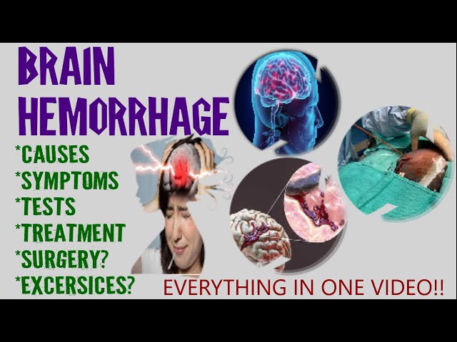 What is BRAIN HEMORRHAGE?| ब्रेन हेमरेज क्या हैं?|Causes, symptoms, treatment & survivability| Hindi