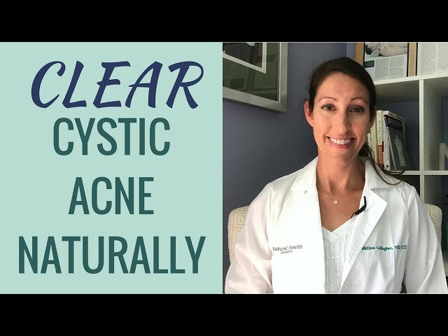 How to Treat and Cure Cystic Acne Naturally | Clinically Proven RESULTS to Get Rid of Acne Fast!!