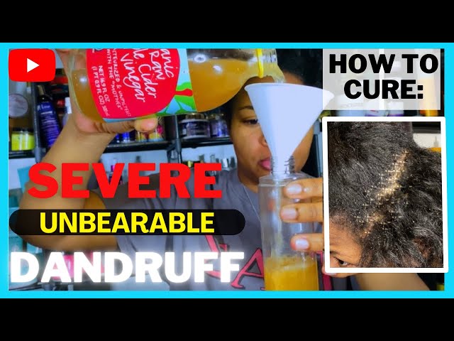 EVERYTHING you need to know about DANDRUFF | The BEST HOMEMADE CURE: