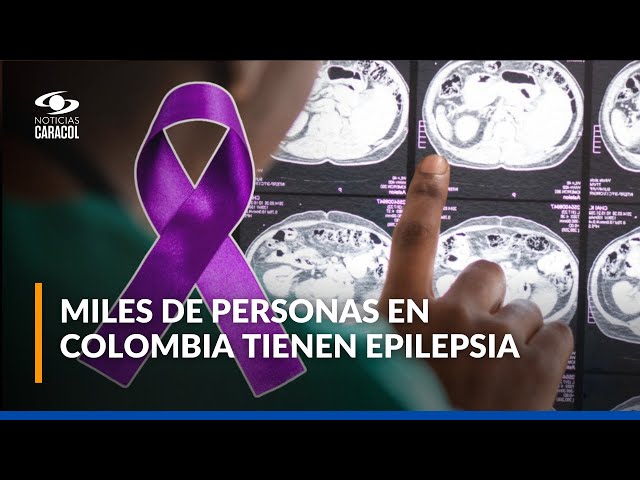 Día mundial de la epilepsia: ¿qué tan común es esta condición?