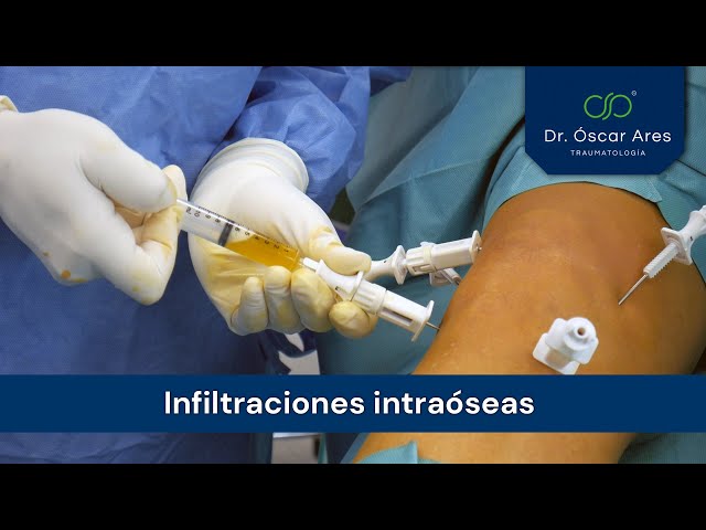 Infiltraciones intraóseas - Dr. Oscar Ares