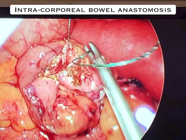 Dr. Iraniha performing bowel anastomosis surgery