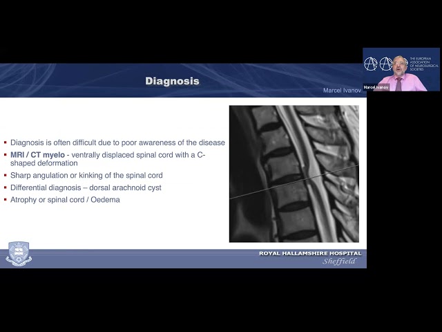 EANS Webinars: Spinal Cord Herniation – a CSF disorder?