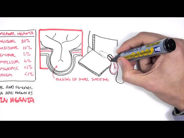 Introduction to Direct and Indirect Inguinal Hernia