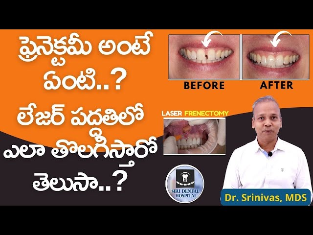 ఫ్రెనెక్టమీ అంటే ఏంటి ? ఎప్పుడు తీస్తారు?| Why Is a Frenectomy Necessary? | Siri Dental Hospital