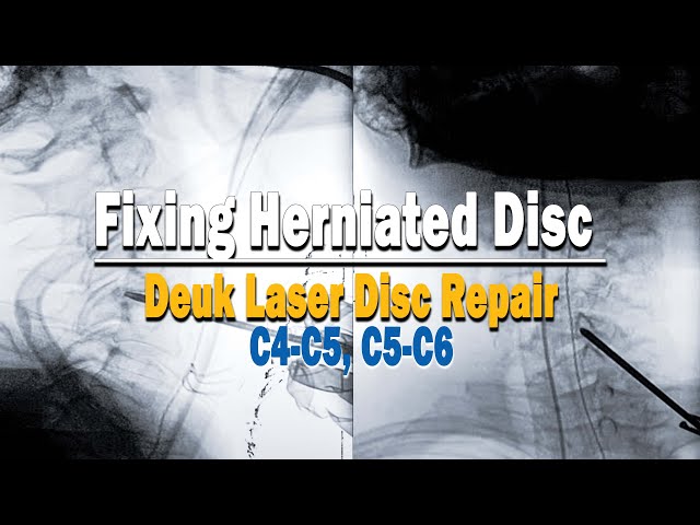 Fixing Herniated Disc at C4-C5, C5-C6 // Deuk Laser Disc Repair