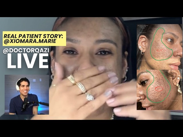 Dr. Qazi x Xiomara Viral Acne Scar Tiktok Discussion | Dr. Qazi Unsponsored Live | 2.3.2025