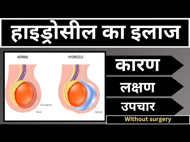 हाइड्रोसील कारण लक्षण एवं इलाज | Hydrocele - Treatment | Causes | Symptoms | in hindi