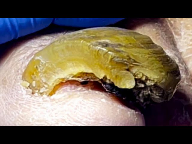 Thick Onychomycosis Becomes Curved, Carefully Remove【Pedicure Master Lin Jun】