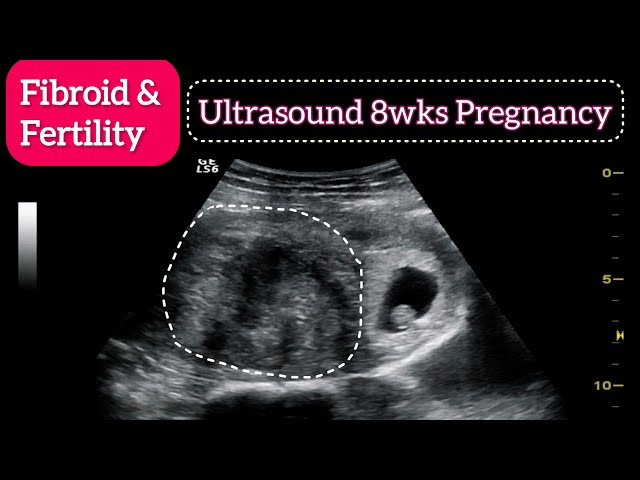 Fibroid & Fertility - Ultrasound of 8wks Pregnancy with Large Fibroid