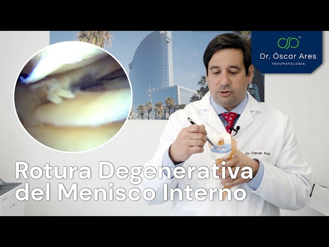 Rotura Degenerativa del Menisco Interno - Dr. Oscar Ares