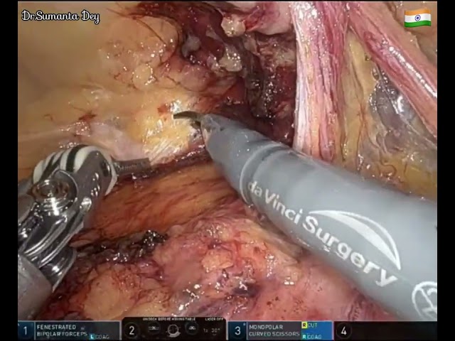 Robotic TAPP repair: Indirect Inguinal Hernia by Dr.Sumanta Dey using DaVinci X