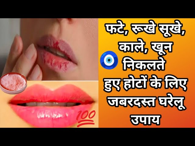 फटे हुए होठों को घर पर ठीक करने का तरीका | Home Remedy to Recover Chapped Lips