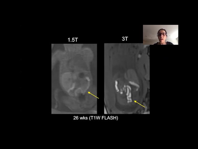 Topics in Fetal Medicine: MR Fetal Imaging