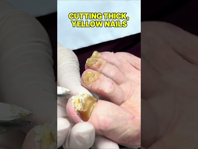 Cutting Thick Yellow Toenails! #foot #drkim #nails