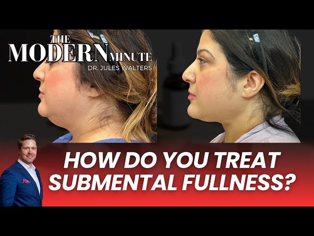 How Do You Treat Submental Fullness?