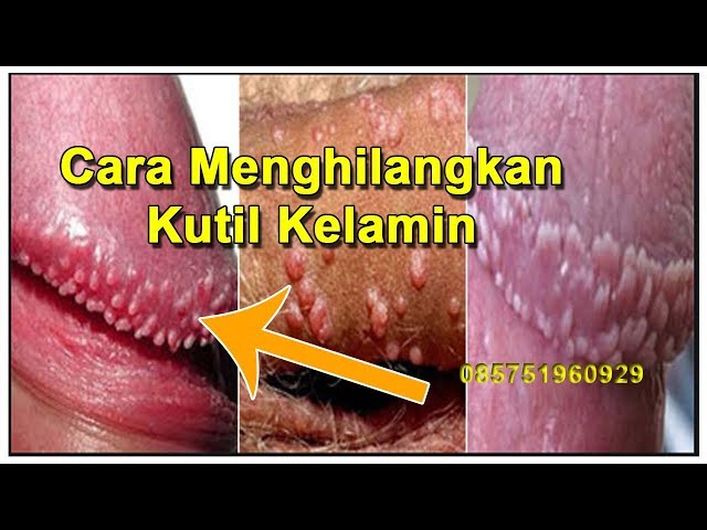 Cara Menghilangkan Kutil Kelamin