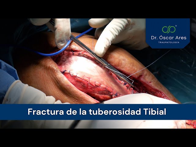 Fractura de la Tuberosidad Tibial - Dr. Ares