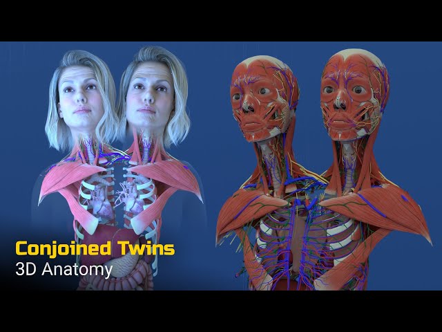 Two Heads, One Body: Anatomy of Conjoined Twins