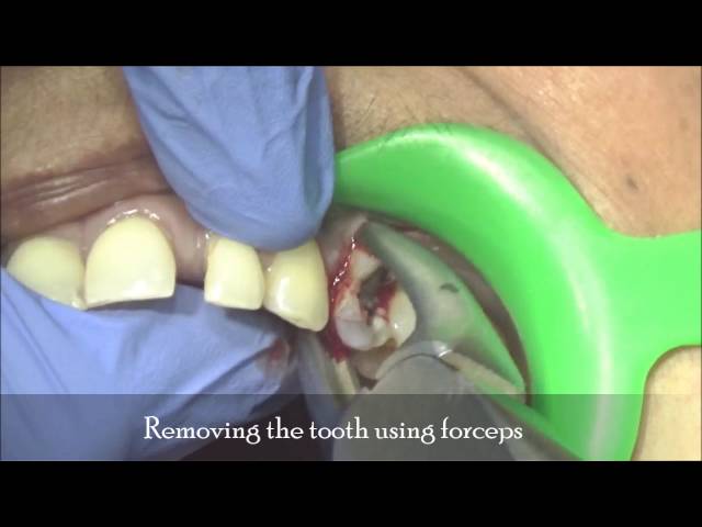 Failed/broken root canal treated upper second premolar -Extraction and immediate BASAL IMPLANTOLOGY