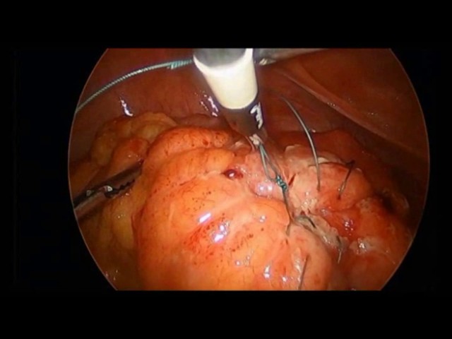 Laparoscopic Specialists   Laparoscopic primary repair of perforated diverticulitis by Dr. Iraniha