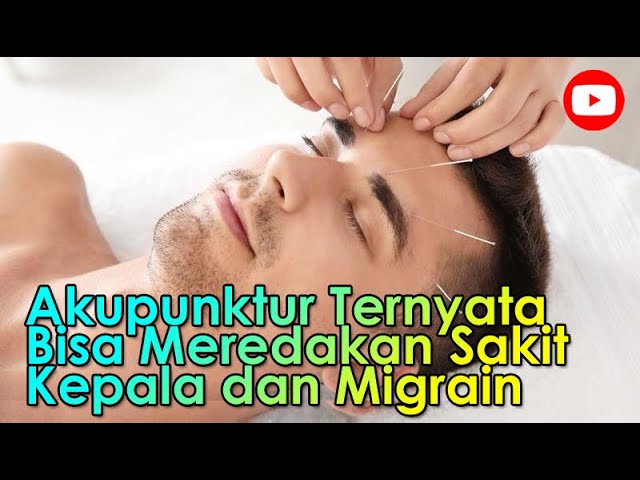 Akupunktur Ternyata Bisa Meredakan Sakit Kepala dan Migrain