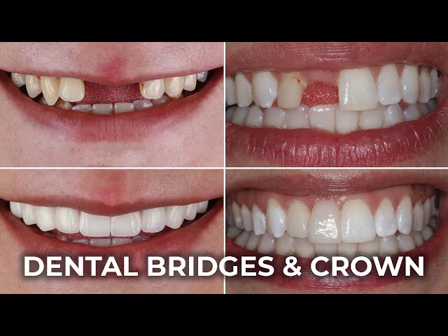 Dental Crowns or Bridges | What’s Best for Your Smile?