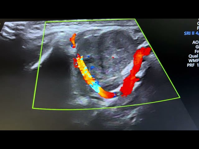 Ultrasound of submandibular sialolithiasis