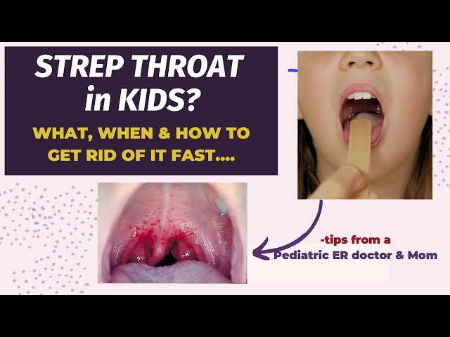 Strep Throat in Kids: How to know, When & How to treat by a Pediatrics ER doctor