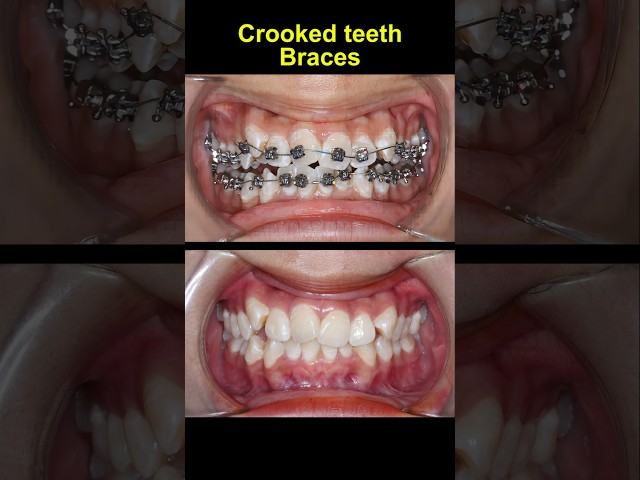 27 months braces for crooked teeth #braces #orthodontist #dentist #dentisty