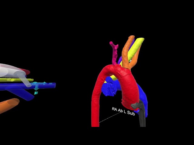 Vascular Rings 3 (Odd) - Right arch with mirror image and right arch with aberrant left subclavian