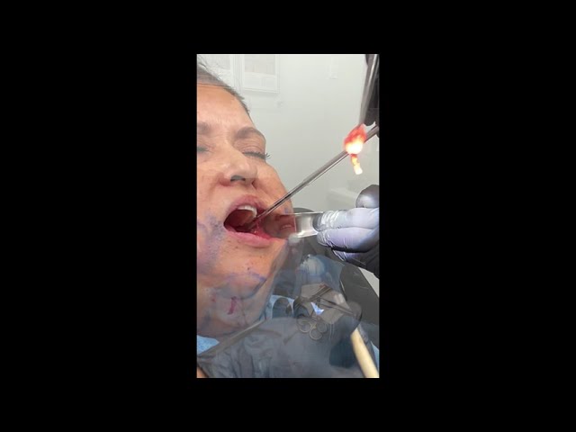 Buccal Fat Pad Removal