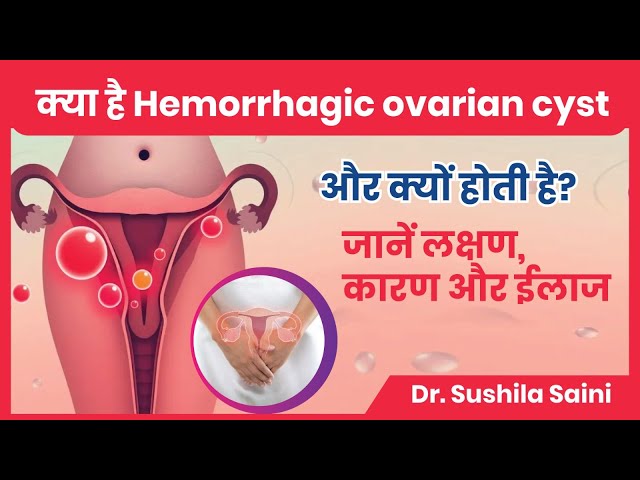 Ovary में Hemorrhagic Cyst कितनी खतरनाक होती है जानें गर्भधारण पर क्या असर पड़ता है?