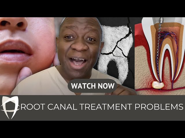 Shocking Root Canal Treatment Problems Exposed in London! 😲 | Top 5 Problems You MUST Know (2023)