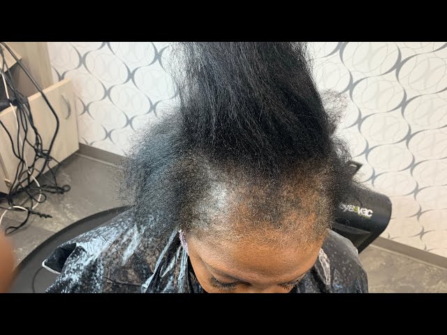 How to fix damaged hair| Hair not growing in hair line| Hair loss entire front hair line