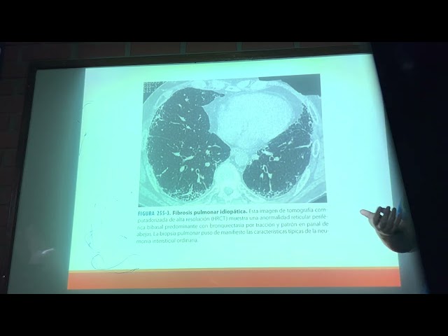 2do parcial NEUMOLOGIA ( enn pulmonar intersticial part2 ) 18-04-2023