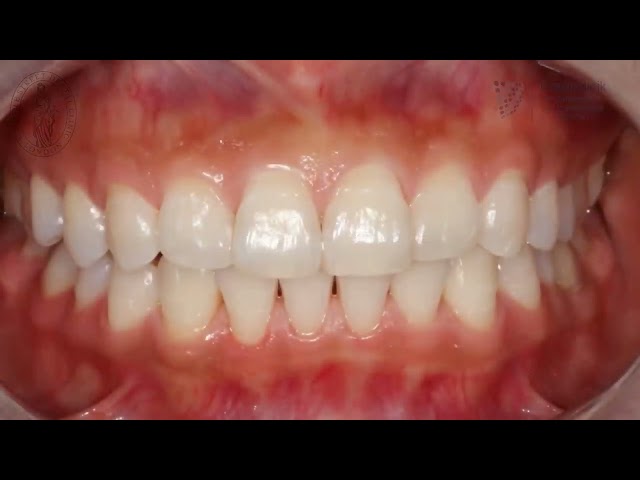 Dental hygiene case study – how professional cleaning transforms oral health